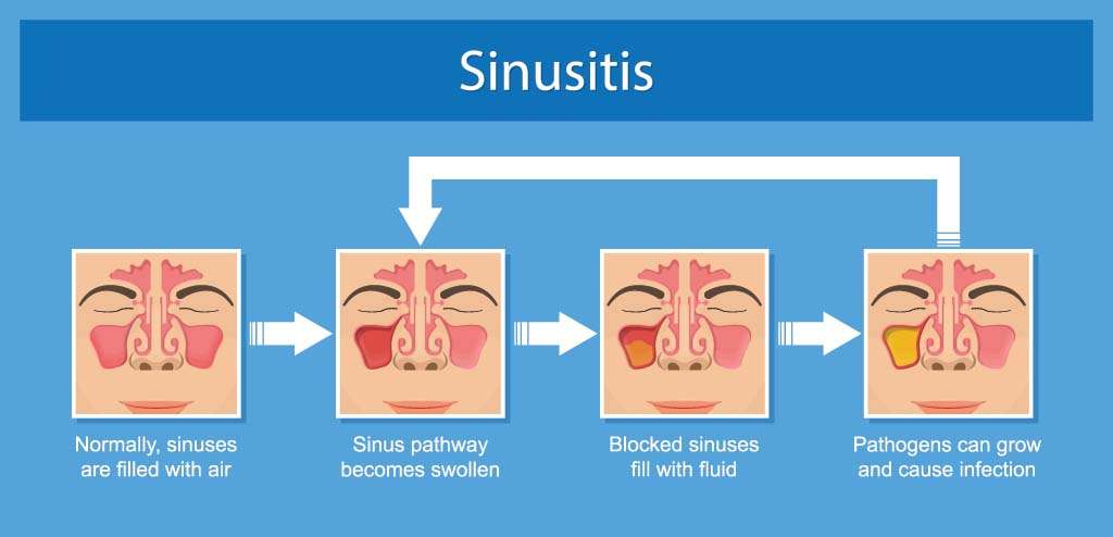 Sinus Infection (Sinusitis), Antibiotic Use