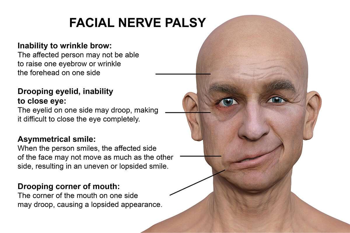 paralysis and speech problems are associated with which condition