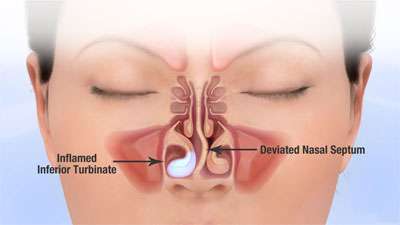 Turbinate Hypertrophy and a Deviated Septum | Symptoms and Treatment