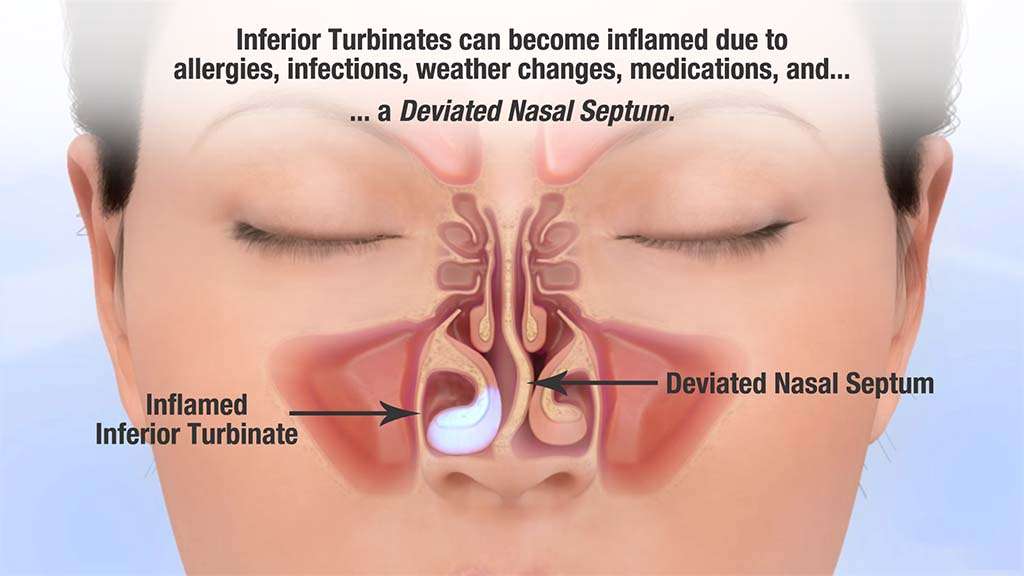 Post-nasal Drip: Symptoms, Causes, Diagnosis, Treatment