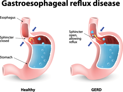 Can acid reflux cause rapid heart rate