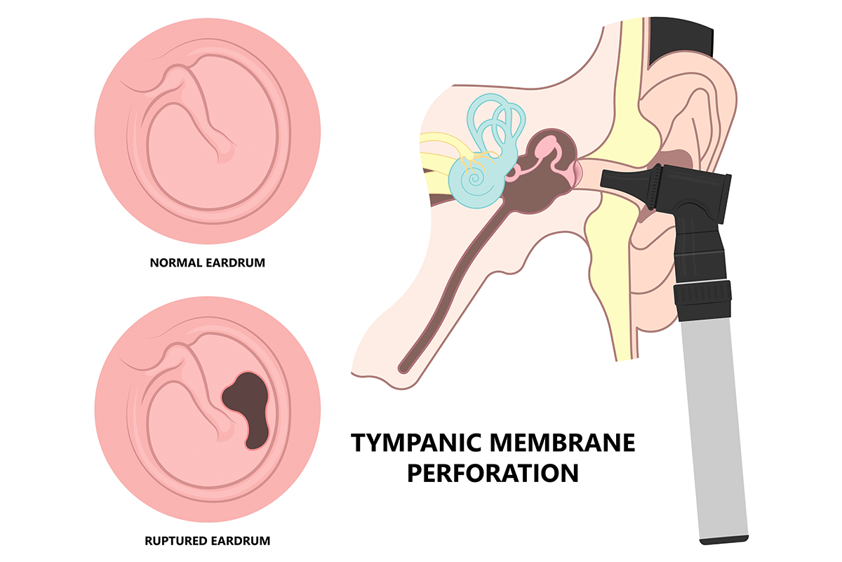 Ear barotrauma: Causes, treatment, and recovery time