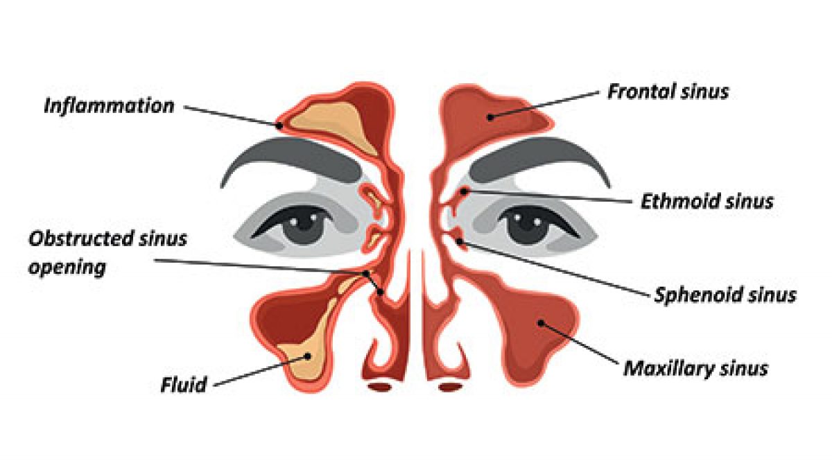 Sinus Headache Location Chart