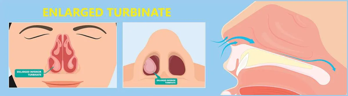 Nasal Turbinate Hypertrophy Inferior Turbinate Hypertrophy swollen Nasal Turbinate Hypertrophy Inferior Turbinate Hypertrophy swollen