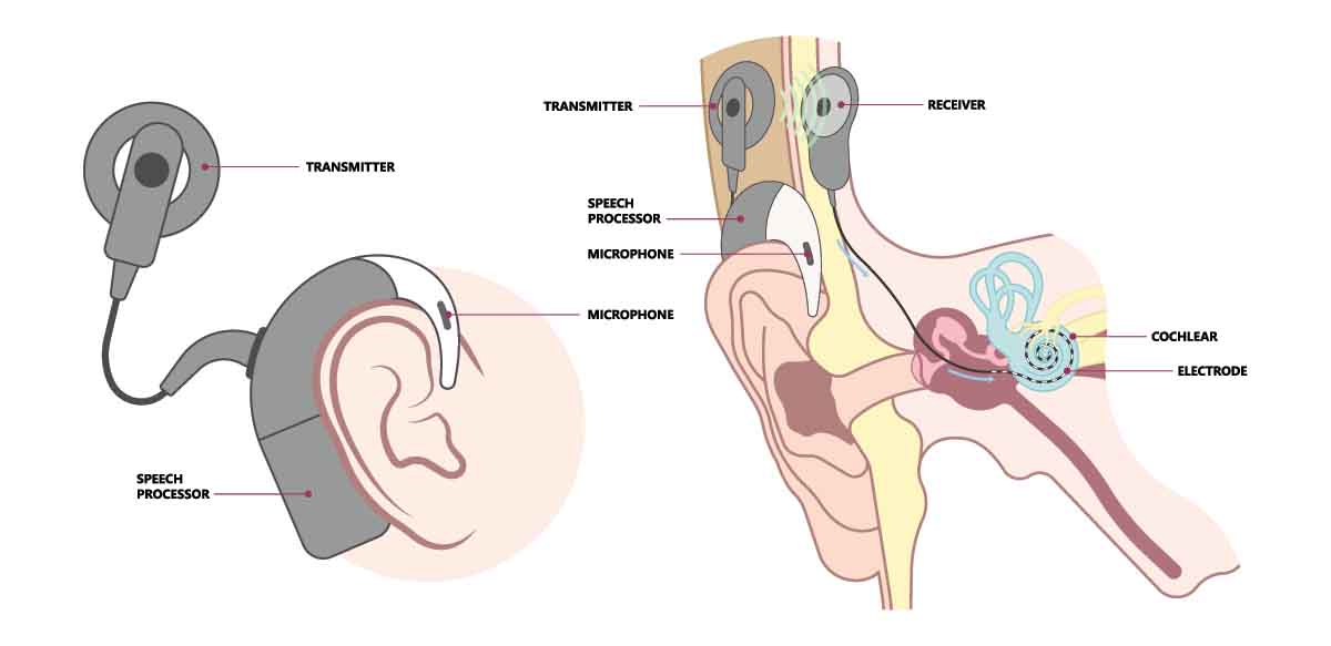 cochlear implant illustration