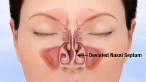 Illustration of a deviated septum