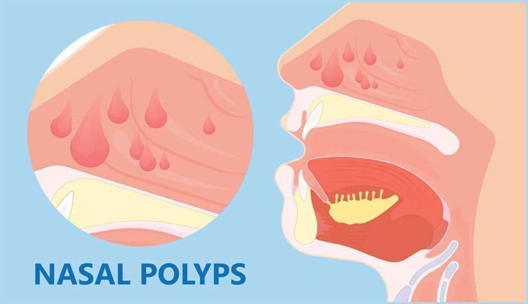 Nasal Polyps illustration