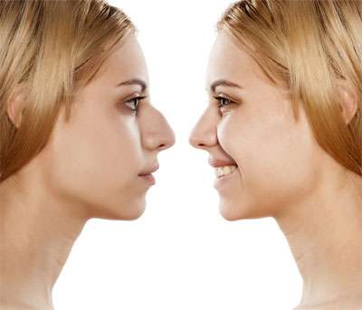 Young Woman - Before and After Cosmetic Rhinoplasty