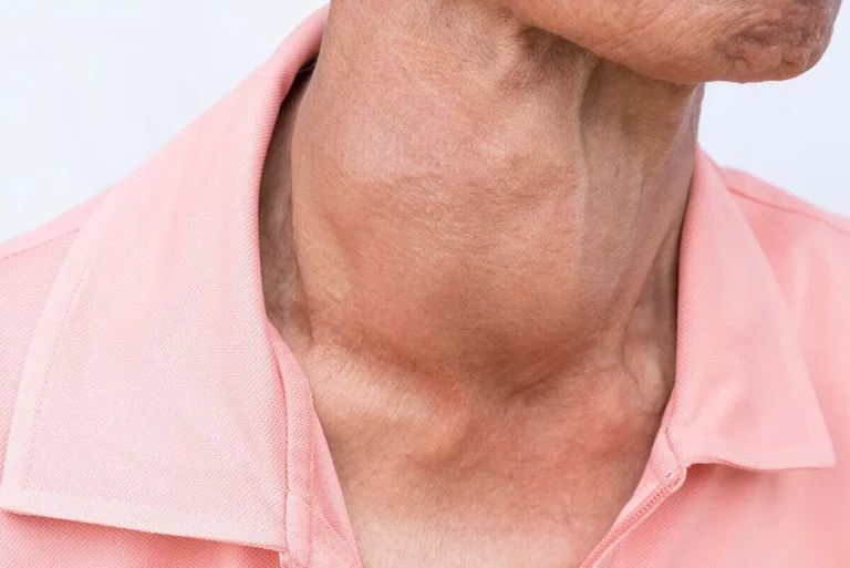 man with a goiter