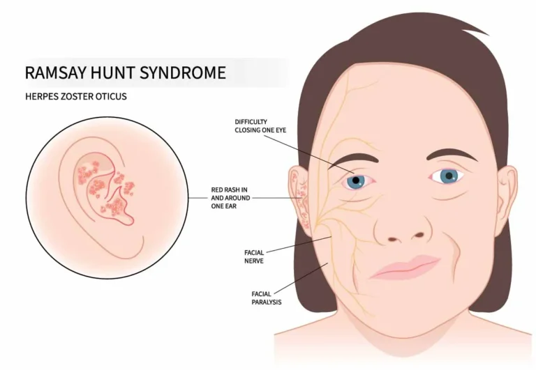 Ramsay Hunt Syndrome Illustration