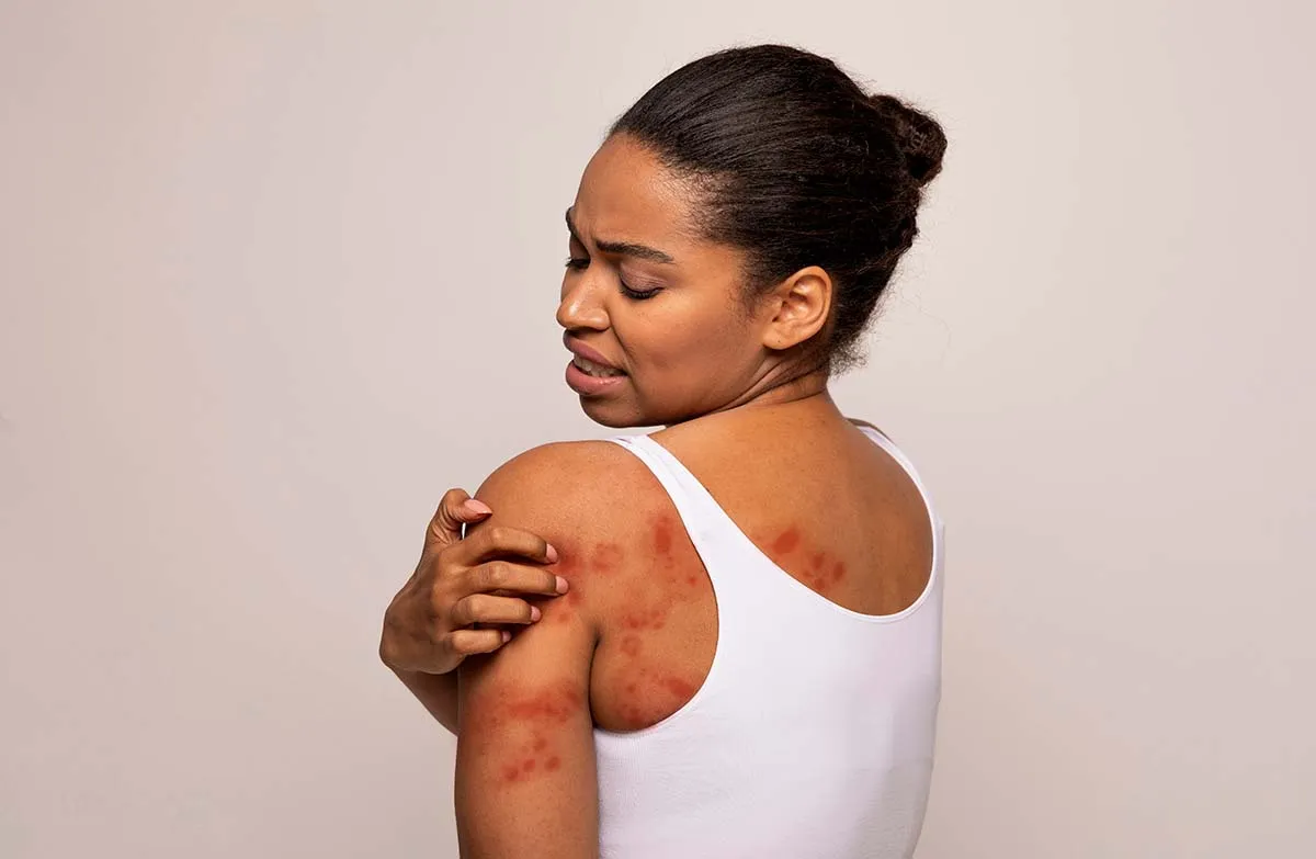 woman with cold urticaria
