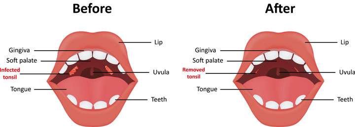 3 Ways To Recover From A Tonsillectomy - Wikihow