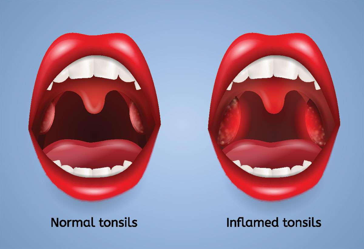 can tonsils grow back after being removed? - tymoff