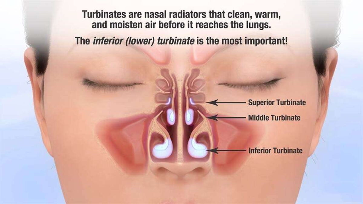 Turbinate Hypertrophy Symptoms and Treatments Philadelphia